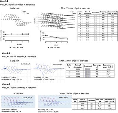 Mild phenotype of CHAT-associated congenital myasthenic syndrome: case series